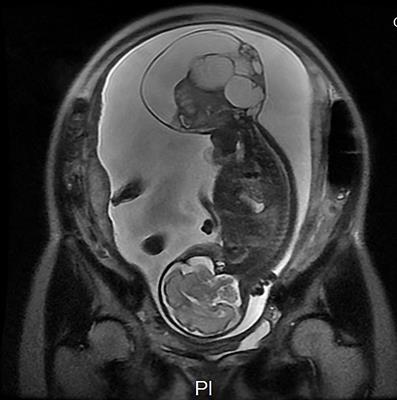 The ex-utero intrapartum treatment (EXIT) strategy for fetal giant sacrococcygeal teratoma with cardiac insufficiency: A case report and review of the literature